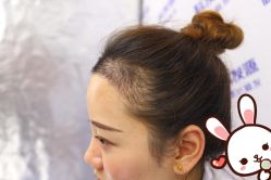 -大麦微针植发丨全国连锁