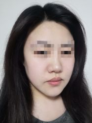 体验后-More摩尔医美の注射线雕光电中心