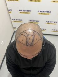 体验前-大麦微针植发全国连锁