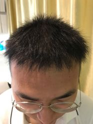 点击看大图 -大麦微针植发全国连锁