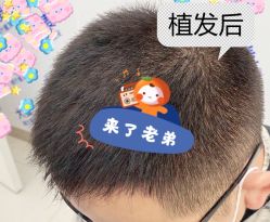 -大麦微针植发全国连锁