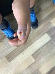 -德哥灰指甲脚气甲沟炎跖疣护理