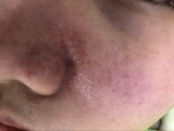 -苗医生草本科技祛痘