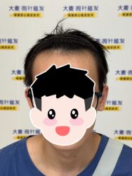 -大麦微针植发全国连锁