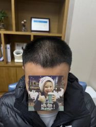 -大麦微针植发全国连锁