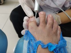 -派恩宜灰指甲鸡眼嵌甲手足癣