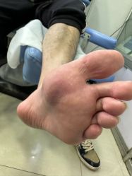 -德哥灰指甲脚气甲沟炎跖疣护理