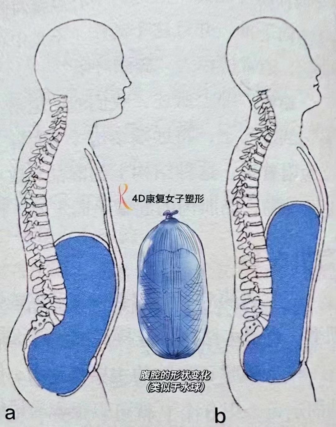 骨盆前倾小腹凸起照片图片