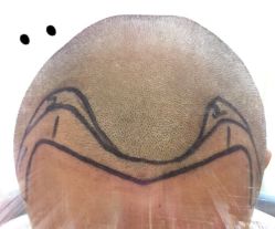 -大麦微针植发全国连锁