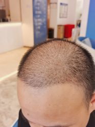 -大麦微针植发全国连锁