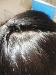 体验后-熙朵美学植发·连锁品牌