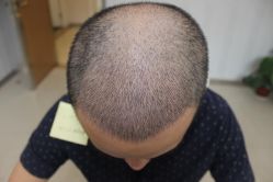 -大麦微针植发丨全国连锁