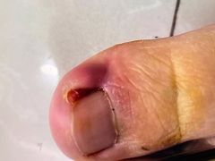 -祖传修脚甲沟炎灰指甲鸡眼