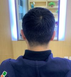 -大麦微针植发丨全国连锁