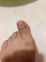 iphone_upload_pic-EPAI·灰指甲·甲沟炎·嵌甲护理