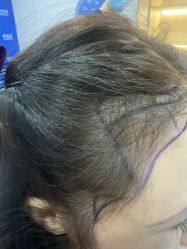 -碧莲盛不剃发植发