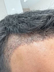 -大麦微针植发全国连锁