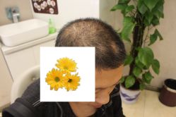 -大麦微针植发丨全国连锁