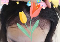 -大麦微针植发全国连锁