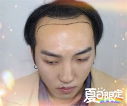 -大麦微针植发全国连锁