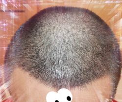 -大麦微针植发全国连锁