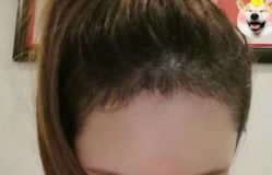 -大麦微针植发丨全国连锁