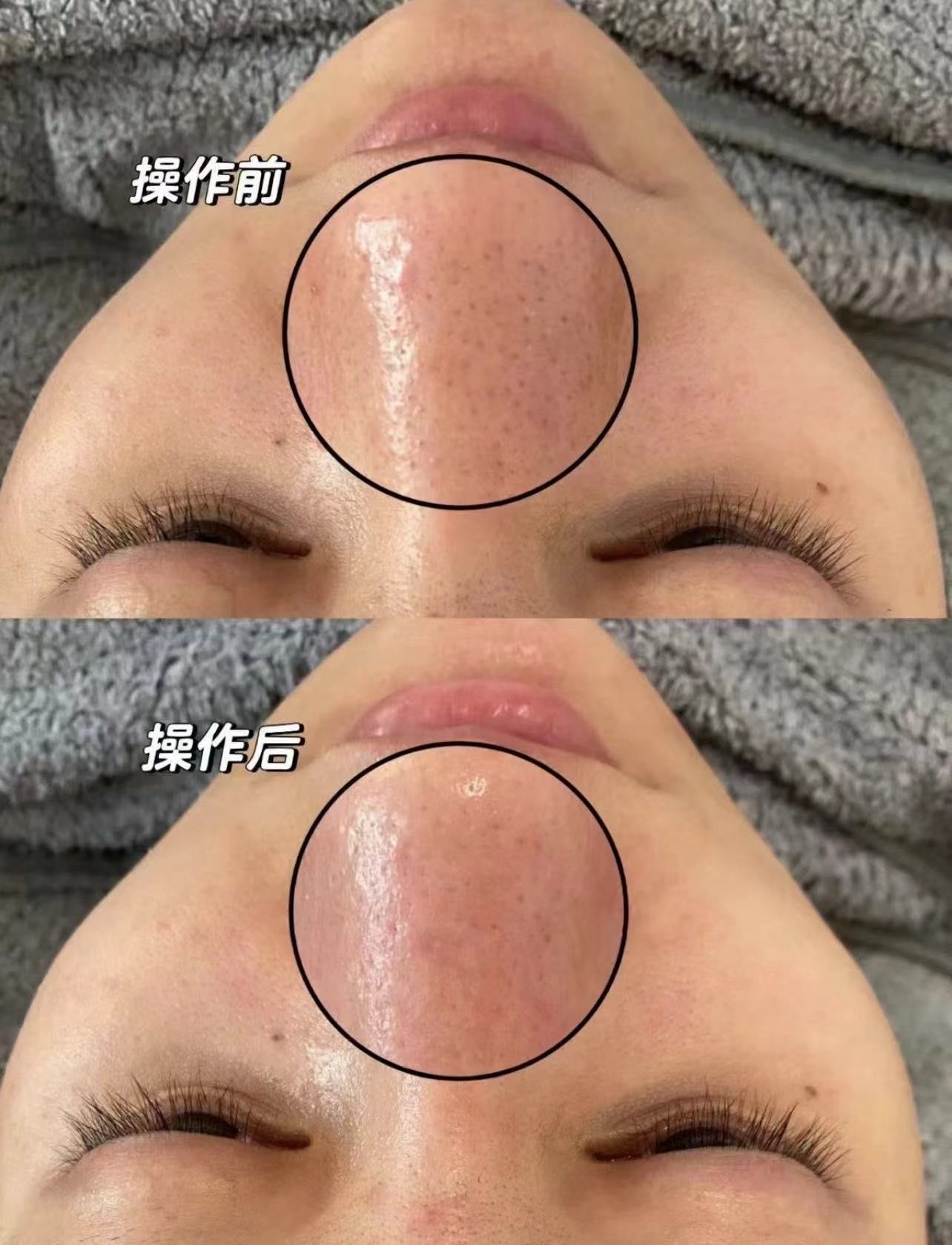 去黑头前后对比图,男女都可做