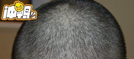 -大麦微针植发丨全国连锁