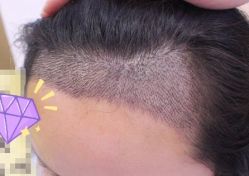 -大麦微针植发丨全国连锁