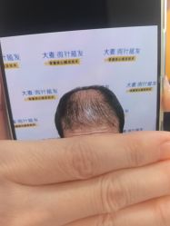 -大麦微针植发丨全国连锁