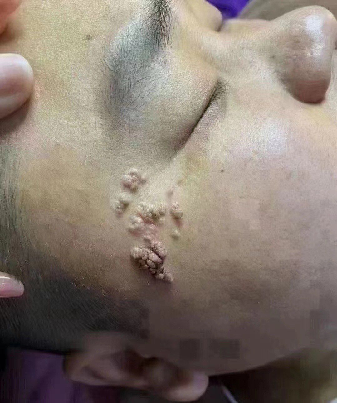 💃扁平疣都上了新闻热门
低危型的病毒🦠
它是皮肤粘膜组织的