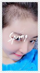 -大麦微针植发全国连锁