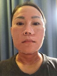 体验后-东剑医学美容·注射美学中心