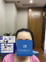 -大麦微针植发全国连锁