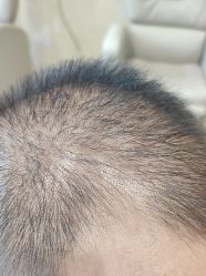 -碧莲盛·不剃发植发