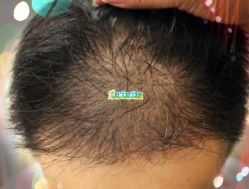 -大麦微针植发全国连锁