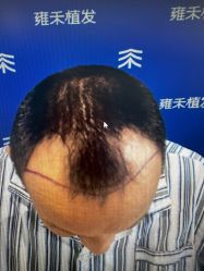 -雍禾植发全国连锁