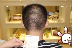 -大麦微针植发丨全国连锁