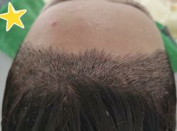 -大麦微针植发丨全国连锁