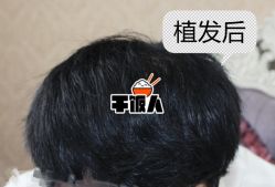 -大麦微针植发全国连锁