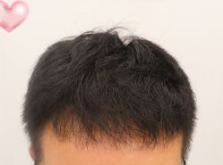-大麦微针植发全国连锁