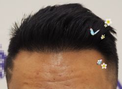 -大麦微针植发全国连锁