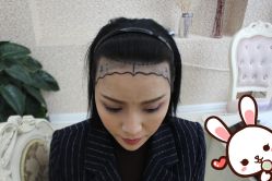 -大麦微针植发丨全国连锁