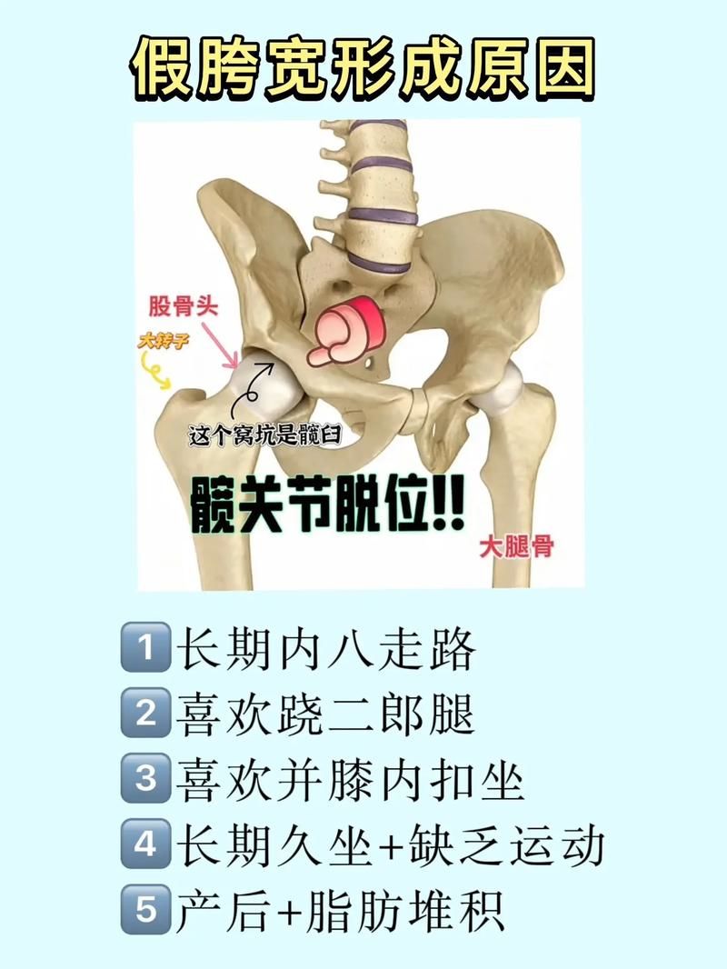 坐着时跷二郎腿等不良习惯,会使髋关节过度内旋,导致股骨大转子向外