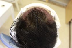 -大麦微针植发丨全国连锁