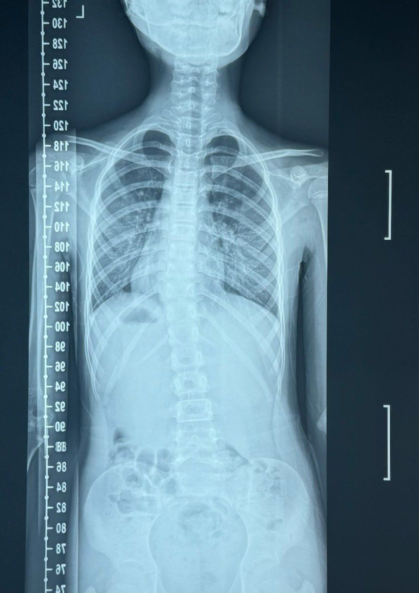 正常脊柱的形状从正面看是直的,而从侧面看是"s"形并带有4个弯弧;反之