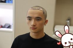 -大麦微针植发丨全国连锁