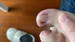 -德哥灰指甲脚气甲沟炎跖疣护理