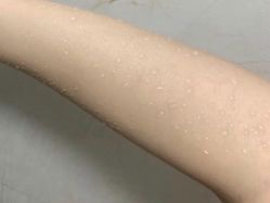 体验后-紫洁俪方（北京）医疗美容