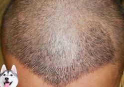 -大麦微针植发丨全国连锁